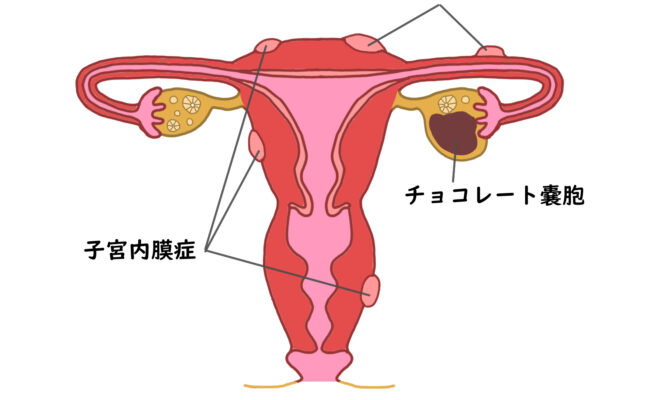 子宮内膜症による体重増加はどの程度の頻度で起こりますか?